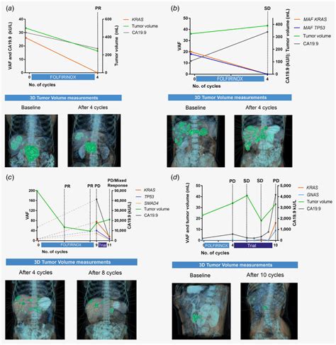 CtDNA Dynamics In Four Individual Patients During Follow Up A Tumor