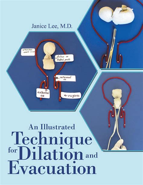 An Illustrated Technique for Dilation and Evacuation eBook by Janice Lee M.D. - EPUB Book ...