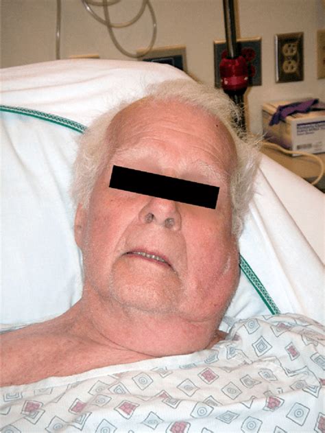 Elderly Male With Cheek Swelling Acute Suppurative Parotitis