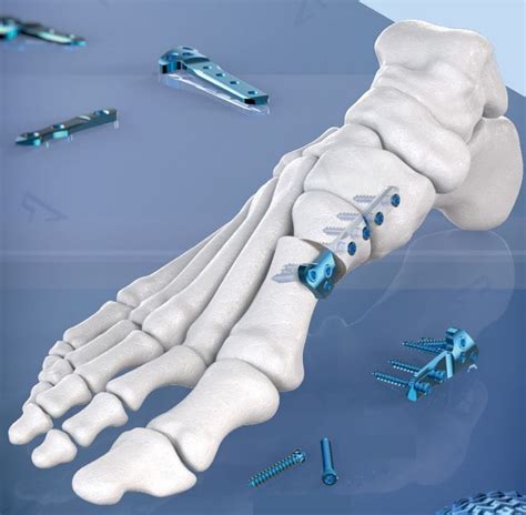 Placa de osteotomía para hallux valgus A TEC AGOMED Medizin Technik