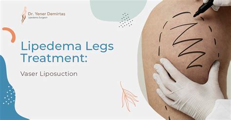 Lipedema Legs Treatment: Vaser Liposuction