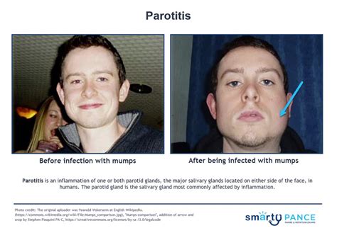 Parotitis Reeldx Smarty Pance