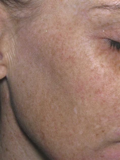 Brown Spots On Skin Causes