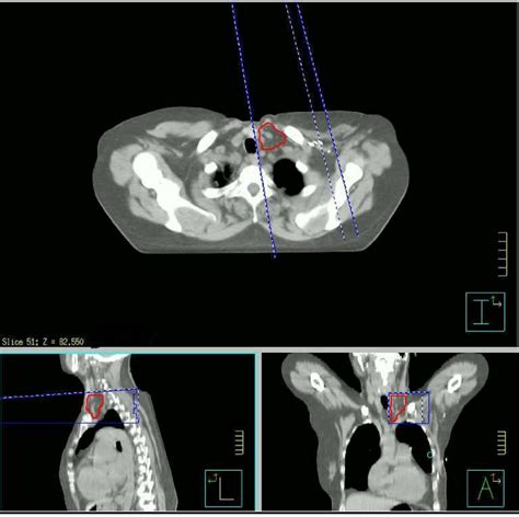 A Typical Contour Of The Supraclavicular Nodal Ctv Note How Care Was Download Scientific