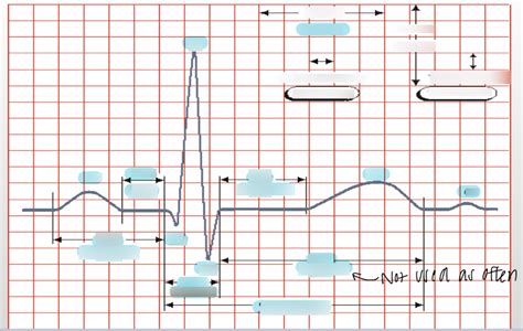 Block Ecg Diagram Ecg Waves Intervals Segments Diagram Quizlet