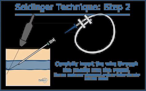 The Seldinger Technique A Comprehensive Guide Patient Safety Experts