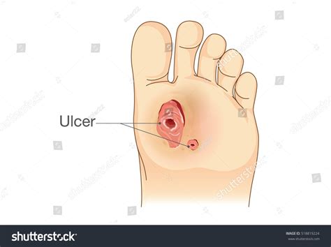 Diabetic Leg Ulcers: Over 125 Royalty-Free Licensable Stock Vectors ...