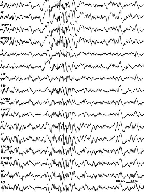 Juvenile Myoclonic Epilepsy Eeg