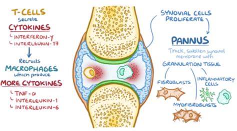 Module Altered Mobility And Arthritis Flashcards Quizlet