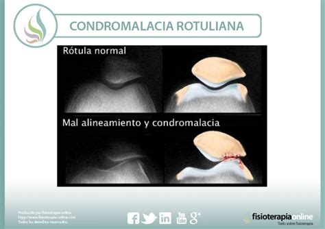 Condromalacia Rotuliana Qué es causas síntomas tratamiento y