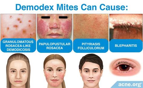 What Are Demodex Mites And What Role Do They Play In Acne