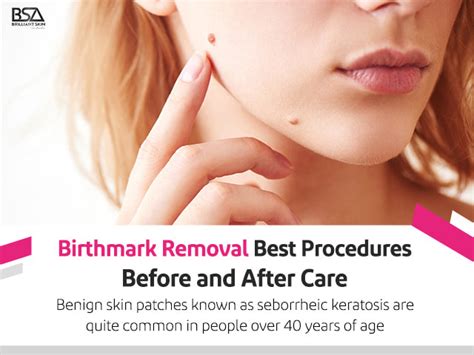 Birthmark Removal Best Procedures Before And After Care