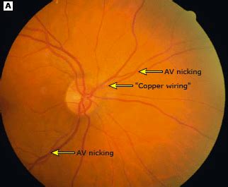 Copper Wiring Av Nicking Eye : An Example Of Acute Hypertensive ...