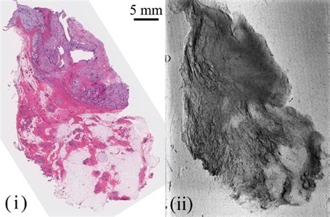 I He Stained Section And Ii Xdfi Image Of A Benign Phyllodes Tumor