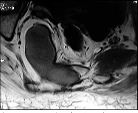 Figure 2 From Epidermoid Cyst Inside Anterior Sacral Meningocele In An