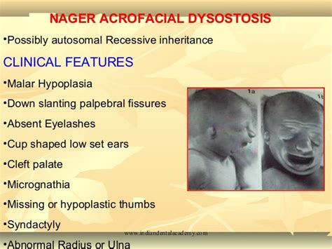 Craniofacial Syndromes