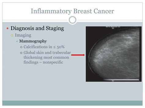 PPT - Inflammatory Breast Cancer PowerPoint Presentation, free download ...