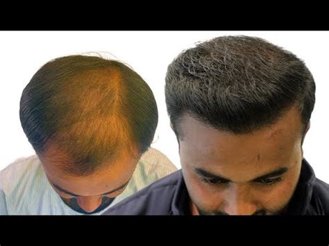 Before And After Remarkable Hair Transformation With 4000 Grafts In