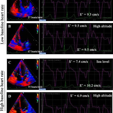 Color Tissue Doppler Imaging And The Curves The Systolic S′ Positive Download Scientific