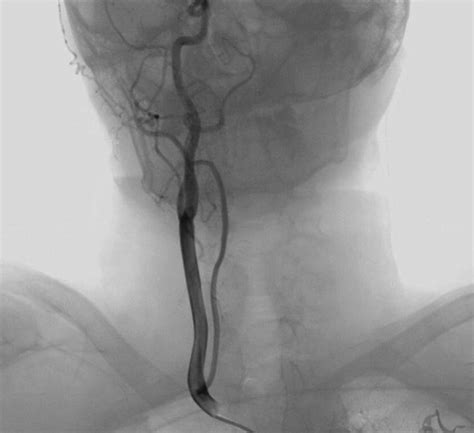 Antero Posterior View Of The Selective Digital Subtraction Angiography