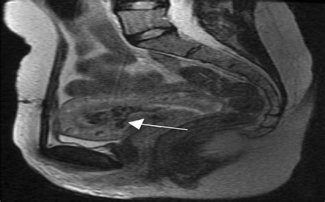 Acquired Uterine Arteriovenous Malformation And Retained Pla