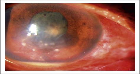 Nocardia Keratitis Current Opinion In Ophthalmology