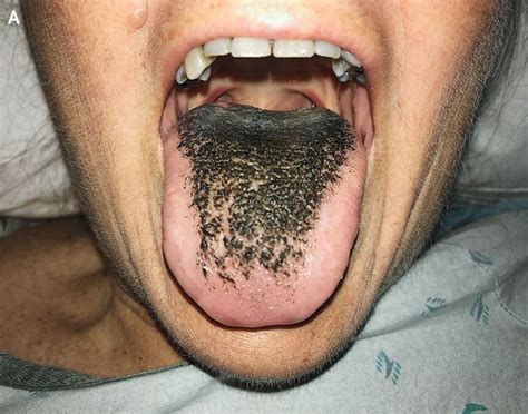 Symptoms Of Hairy Tongue Medizzy