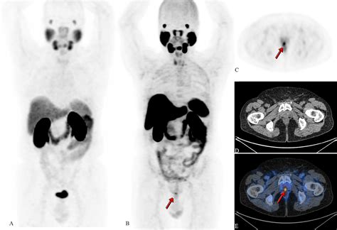 Frontiers PSMA PET In Imaging Prostate Cancer