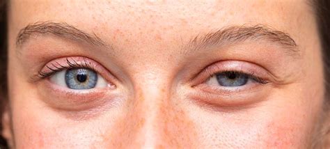 What Is Ptosis And How Do I Treat It Plano Eye Health