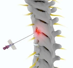 Facet Joint Injection New Albany Jeffersonville In Facet Joint