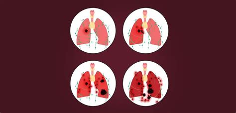 What are the various stages of lung cancer? | Dr Arvind Kumar