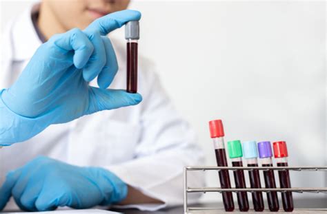 O Que Significa Vpm No Exame De Sangue - O que significam as siglas PDW e VPM no resultado de um hemograma?