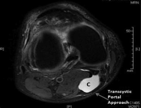 Arthroscopic Treatment Of Popliteal Cysts Arthroscopy Techniques