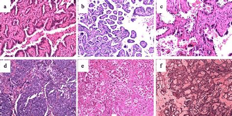 Lung Carcinoma Histology