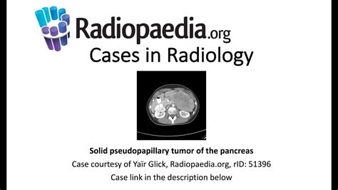 Solid Pseudopapillary Tumor Of The Pancreas Cases In