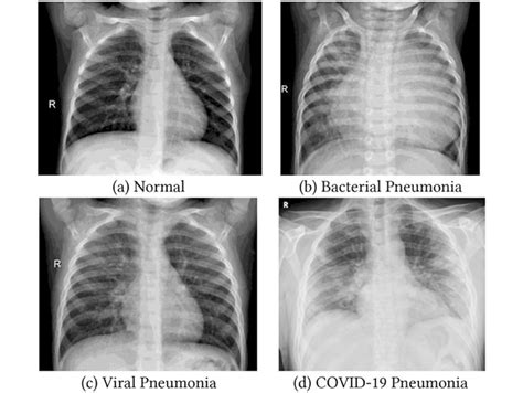 Example of Chest X-Ray Images a Normal Image b Bacterial Pneumonia... | Download Scientific Diagram