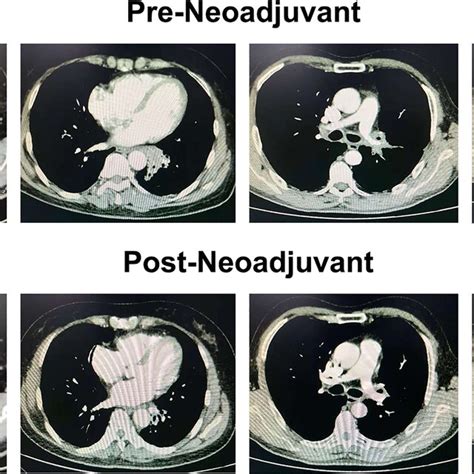 Four Typical Contrast Enhanced Computed Tomography Ct Scans In Download Scientific Diagram