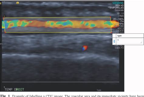 Figure From Colour Doppler Ultrasound Of Temporal Arteries For The