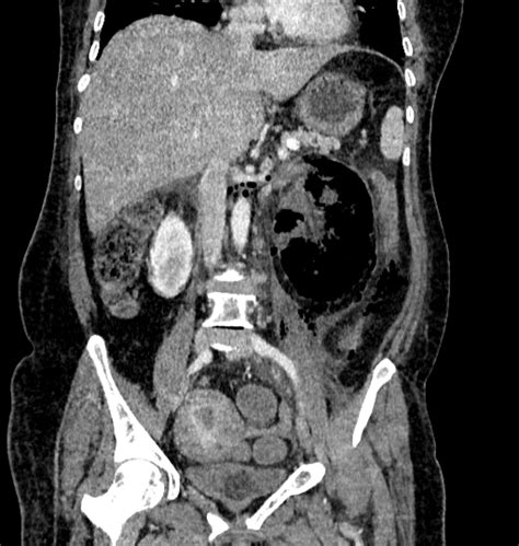 Emphysematous Pyelonephritis Image Radiopaedia Org