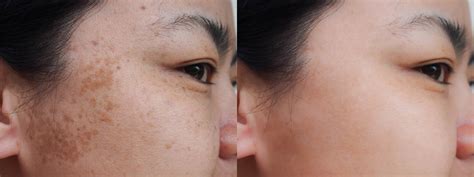 DARK SPOTS AND HYPERPIGMENTATION: THE CAUSES — Morganna's Alchemy Skin Care