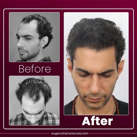 Absolute Look Change With Natural Result At Eugenix Best Hair