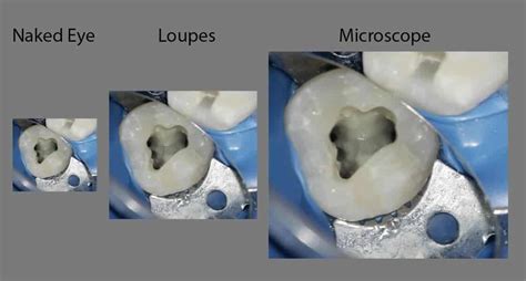 MICRO ENDODONTICS | FMS DENTAL HOSPITAL