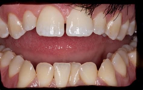 Teeth Whitening Before And After Stains