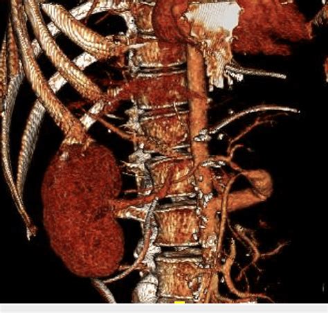 Figure 1 From Endovascular Treatment Of A Multi Visceral Aortic Conduit