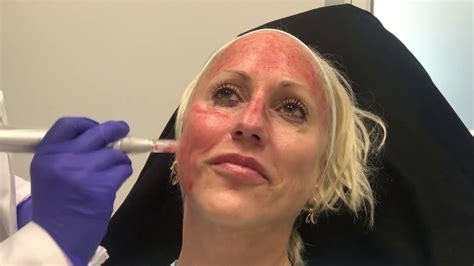 Microneedling With Stem Cells Youtube