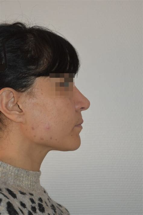 Rhinoplastie Conservatrice ultrasonique avant après