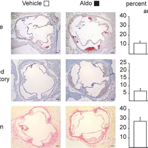 Aldo Promotes An Inflammatory Plaque Phenotype The Percentage Of