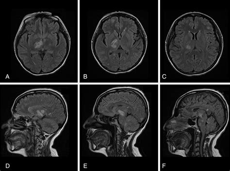 Hemichoreahemiballism An Uncommon Presentation Of Central Nervous