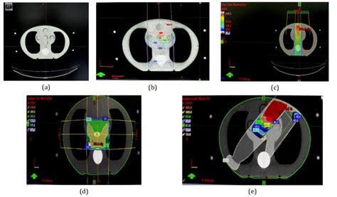 A Ct Image Of Cirs Phantom Treatment Planning For B Case 1 C Download Scientific Diagram