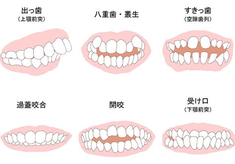 歯並び、噛み合わせ矯正治療 ｜ 浅草歯科・歯医者≪いしやま歯科・矯正歯科 浅草≫台東区インビザライン・矯正歯科・小児矯正・歯科医院